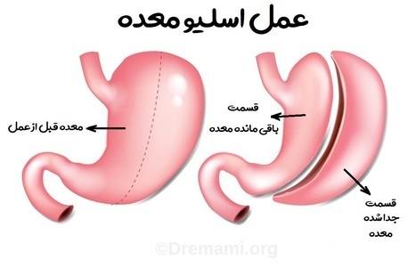 گاسترکتومی آستینی یا اسلیو معده، یک روش جراحی برای کاهش وزن است. این روش معمولاً از طریق لاپاراسکوپی انجام می‌شود، که در آن جراح ابزارهای جراحی را از طریق چند برش کوچک وارد شکم بیمار می‌کند. در طی گاسترکتومی آستینی، حدود 80 درصد از معده برداشته می‌شود و معده شکل و اندازه‌ای شبیه موز به خود می‌گیرد. کوچک کردن اندازه معده، مقدار غذای مصرفی شما را محدود می‌کند.