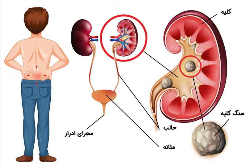 سنگ کلیه ، پیشگیری و درمان در طب سنتی