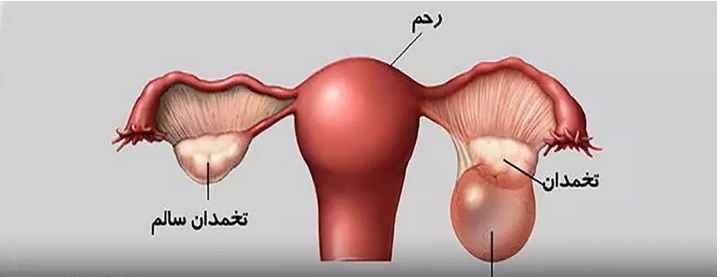  پارگی کیست تخمدان