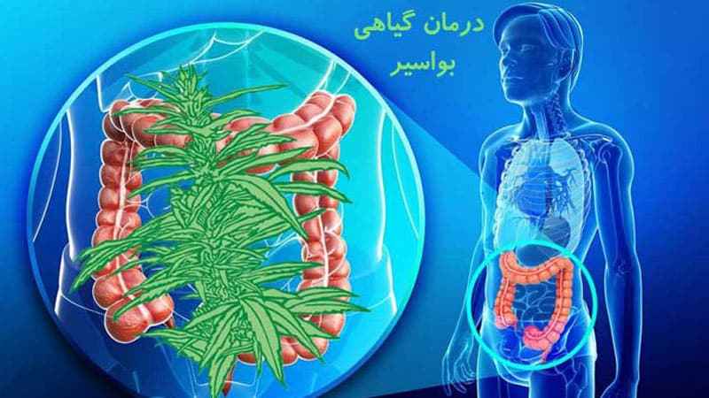 روش خانگی درمان بواسیر