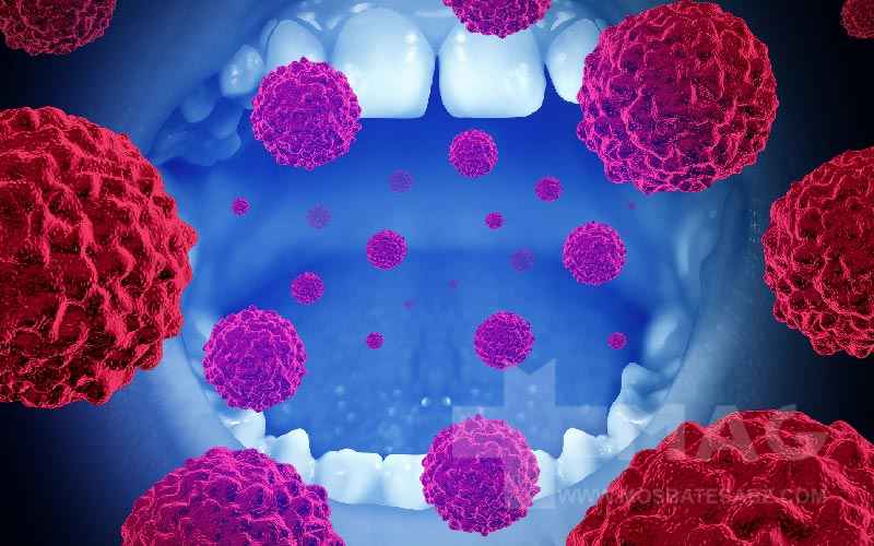 سرطان دهان چیست