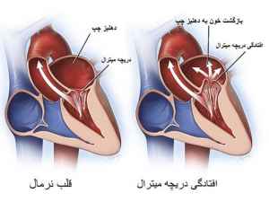 افتادگی دریچه میترال در خانم