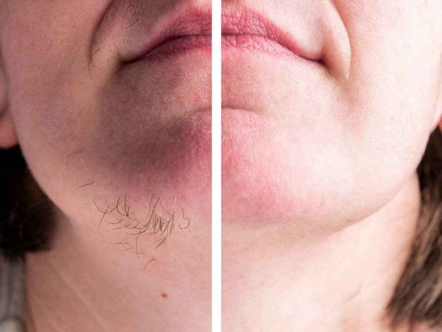 موهای زائد یا هیرسوتیسم، رشد غیرطبیعی موهای ضخیم و تیره در نواحی معمولاً بدون مو (مانند صورت، سینه، کمر) در زنان است. این عارضه اغلب ناشی از افزایش هورمون‌های مردانه (آندروژن) است.