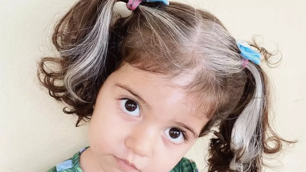 سفید شدن موها یک عارضه همه‌گیر است که می‌توان گفت رابطه مستقیمی با افزایش سن و پیری دارد. هرچند این امکان وجود دارد که علت سفید شدن مو، جز این باشد و فرد در هر زمانی از زندگی، حتی کودکی و نوجوانی هم به آن مبتلا شود.