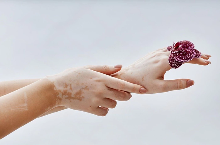 علائم اولیه پیسی