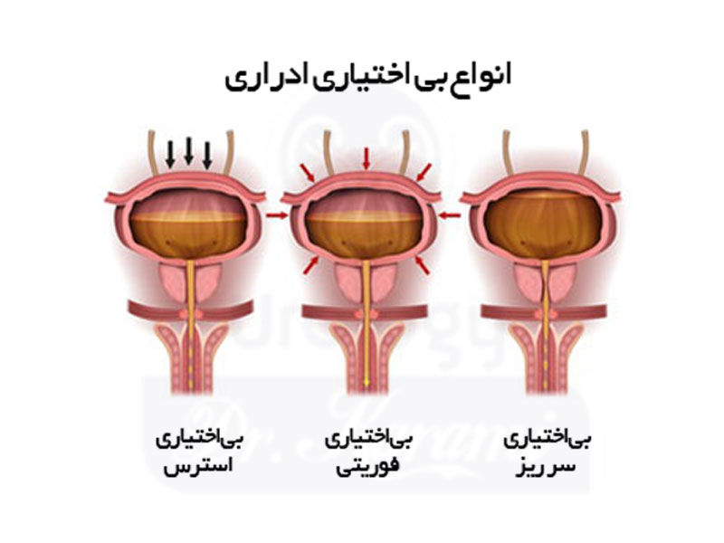 تکرر ادرار، نوعی بیماری است که در همه نوع سن و جنسی دیده می شود، تعریف تکرر ادرار را می‌توان این گونه گفت: “نیاز بیشتر برای رفع ادرار” به طور کلی هر انسان بالغ روزانه حدود ۷۰۰ میلی لیتر تا ۳ لیتر ادرار دفع می‌کند و اگر این میزان افزایش پیدا کند فرد به دفعات بیشتری برای تخلیه ادرار نیازمند است.