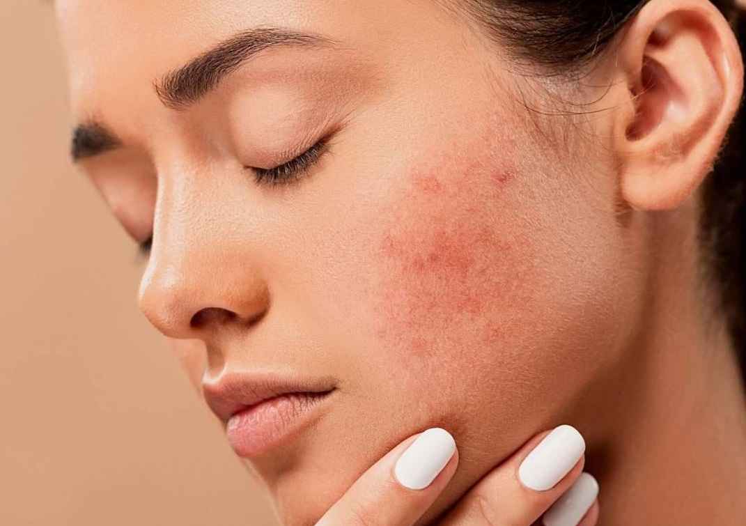 با جوش های زیر پوستی خداحافظی کنید